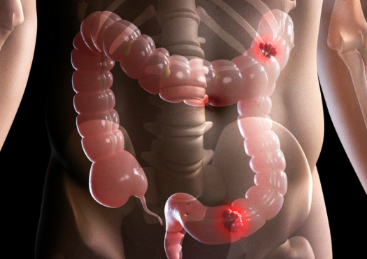 GI Cancers Treatment Thumbnail